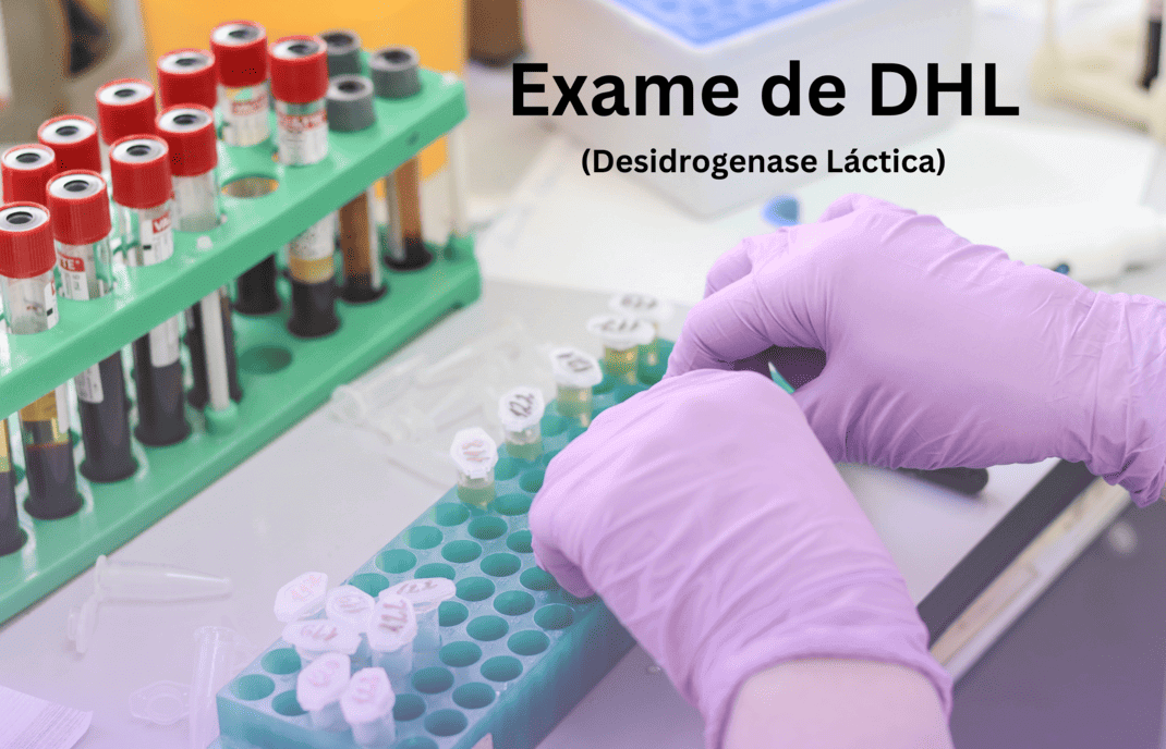 Exame de DHL: Desidrogenase Láctica, Para Que Serve?
