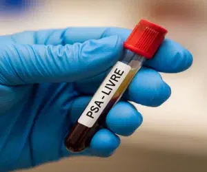 exame-psa-livre-entenda-a-diferenca-para-o-psa-total-saude-diagnostica