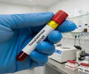 exame-de-toxoplasmose-igg-e-igm-entenda-para-que-serve-saude-diagnostica